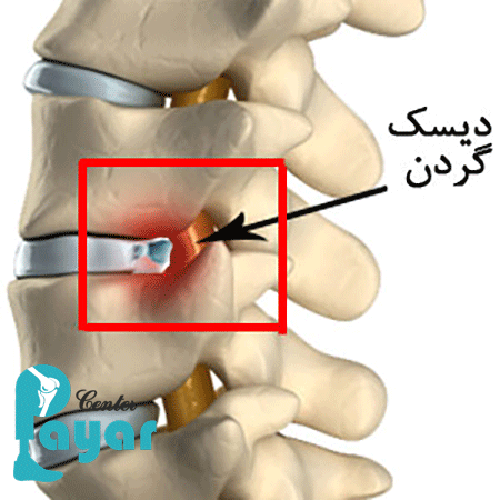 درمان دیسک گردن بدون جراحی یا پیشگیری دیسک گردن؟