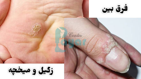 فرق زگیل و میخچه