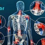 آرتروز چیست؟ ⭐ و چند نوع آرتروز وجود دارد؟