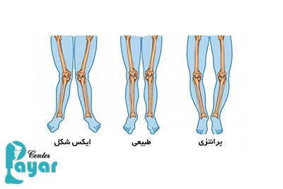 اصلاح انحراف زانو (زانو ضربدری و زانو پرانتزی)