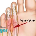 بیماری مورتون نوروما چیست؟ (علت و علائم و درمان)