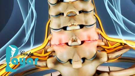 نشانه های آرتروز کمر چیست