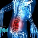 آرتروز کمر چیست؟ (درمان ساییدگی مهره کمر)