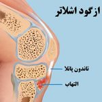 ازگود اشلاتر چیست؟ علت و درمان ازگود اشلاتر