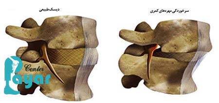 سرخوردگی مهره های کمر