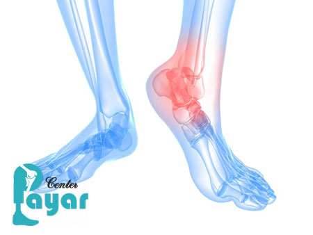 خشک کردن مفصل مچ پا یا آرترودز چیست