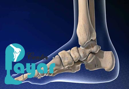 در مورد عوارض عمل فیوژن مچ پا، چه میدانید؟