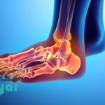 عوارض عمل فیوژن مچ پا یا آرترودز ⭐چیست؟