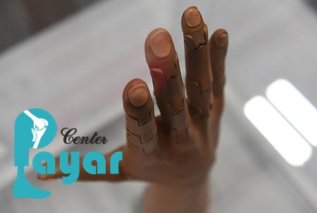 قیمت پروتز انگشت دست در اصفهان چقدر است
