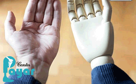 ساخت جدیدترین پروتز دست در ایران و در کلینیک پایار