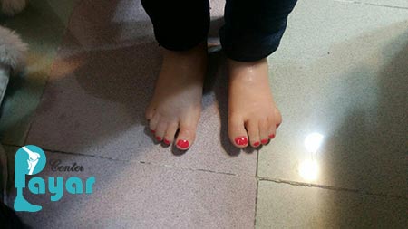 پروتز مچ پا چیست و عملکرد آن