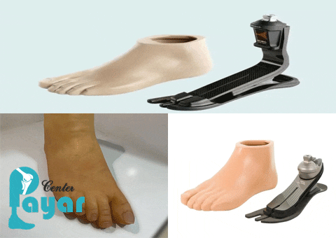 پروتز مچ پا چیست و چند نوع دارد