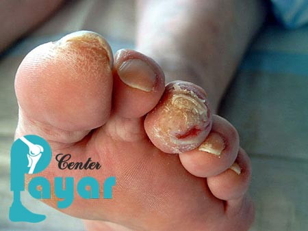 تفاوت پای مصنوعی با پروتز پای دیابتی چیست؟