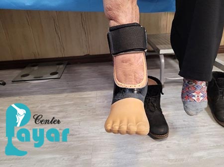 پروتز پای دیابتی