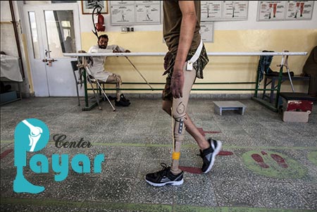 ایمپلنت پای مصنوعی، جدیدترین پای مصنوعی در ایران