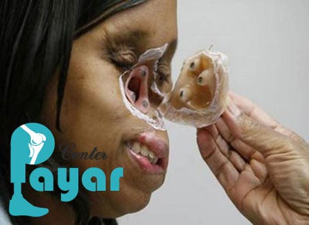 کاربرد پروتز بینی بدون جراحی