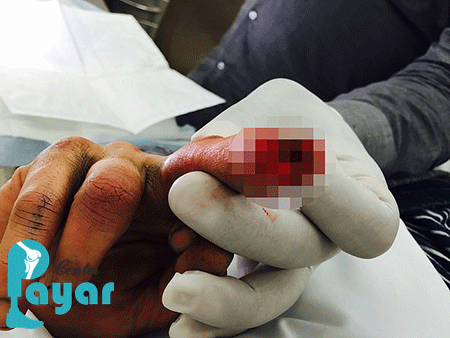 آیا روش بازسازی انگشتان قطع شده و ترمیم انگشت له شده یکی است؟