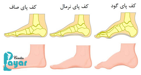 بهترین راه برای ساخت کفی طبی برای قوس کف پا چیست؟