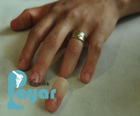 قیمت پروتز انگشت قطع شده چقدر است؟ برای ساخت آن به کجا مراجعه کنیم؟