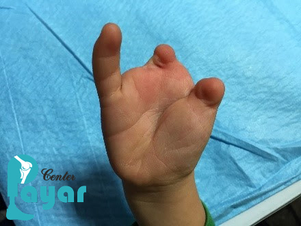 مهم ترین اقدامات، قبل از انتقال انگشت قطع شده به بیمارستان تخصصی پیوند انگشت چیست؟