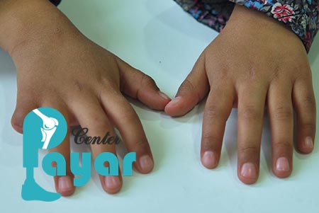 کاشت ناخن انگشت قطع شده چیست؟