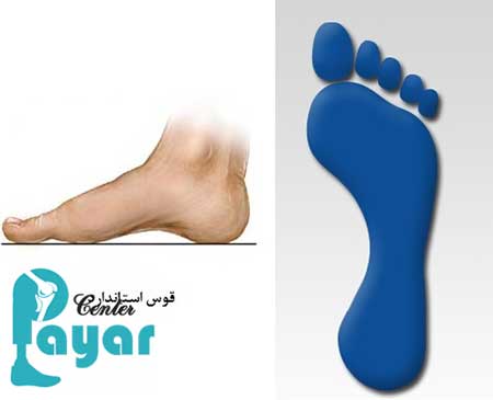 کفش مناسب کف پای قوس دار بهتر است یا کفی طبی برای قوس کف پا