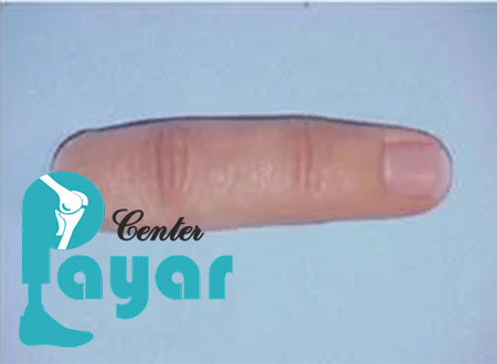 در بیمارستان تخصصی پیوند انگشت چه نکاتی در خصوص تغذیه بعد از پیوند انگشت ذکر می شود؟
