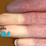 علت سیاه شدن انگشت بعد از پیوند چیست؟⭐خطرناک است؟