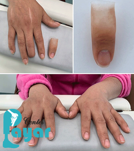 متریال به کار برده شده در ساخت پروتز انگشت دست