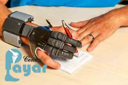 پروتزهای ثابت دست با سایر انواع پروتز دست در تهران چه تفاوتی دارند؟