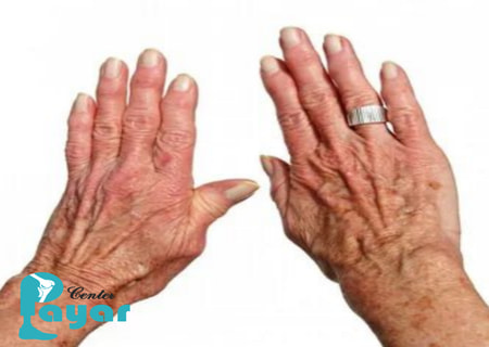 آرترودز و فیوژن استخوان