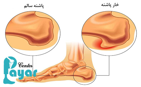 آیا خار پاشنه خطرناک است؟آیا با کفی و کفش طبی درمان میشود؟