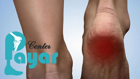با درمان خار پاشنه در منزل آشنا شوید!؟