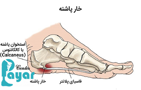 آیا درمان خار پاشنه با پیاز امکان دارد؟