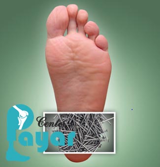 درمان خار پاشنه با حنا به چه شکل است