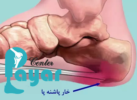 از محدودیت های درمان خار پاشنه با پیاز چه می دانید؟