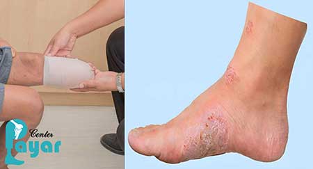 قطع پای دیابتی چیست؟ و چرا کار به قطع عضو می رسد