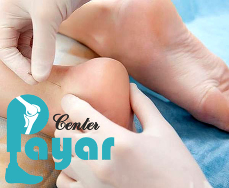 کفش مناسب برای درد پاشنه چه مشخصاتی باید داشته باشد؟