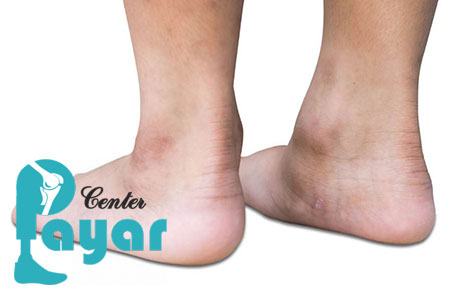 مفصل مصنوعی مچ پا چه تفاوتی با پروتز مچ پا دارد؟