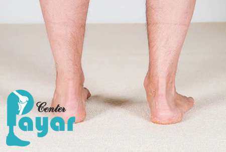آیا ساخت و نصب پروتز مچ پا، یکی از عوارض خشک کردن مفصل مچ پا است؟