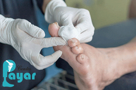 روش های جلوگیری از قطع پای دیابتی