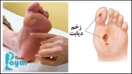 نحوه جلوگیری از قطع پای دیابتی، آن را جدی بگیرید