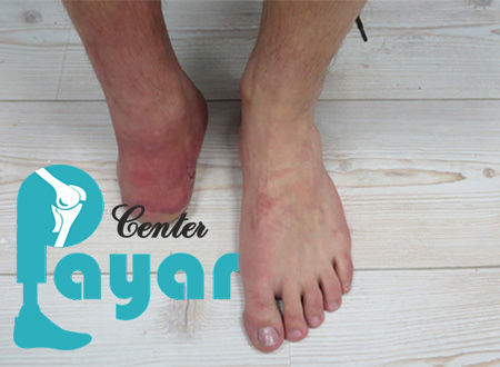 نحوه جلوگیری از قطع پای دیابتی