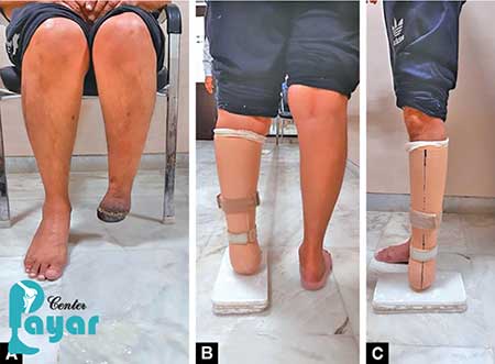 آیا میدانید دلایل قطع پا از مچ چیست