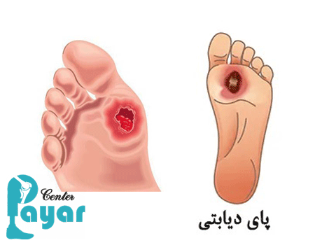 آیا می دانید علائم قطع پای دیابتی در افراد دیابتی چیست؟