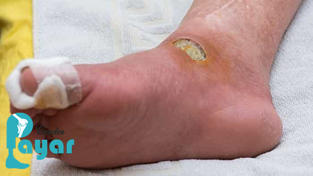 با مراقبت های بعد از عمل قطع انگشت پا در بیماران دیابتی اشنا شوید!؟