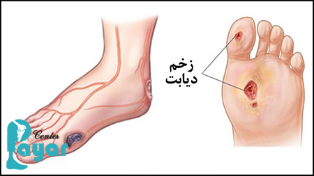 با مهم ترین نکات مراقبت بعد از قطع پای دیابتی آشنا شوید؟