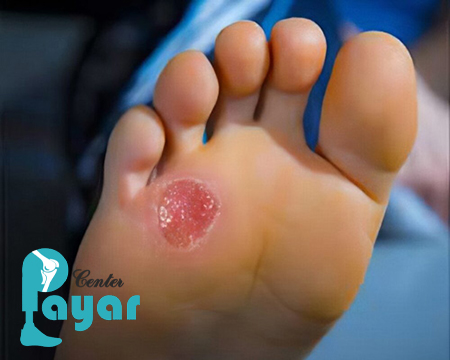 بدترین عوارض بعد از قطع پای دیابتی چیست؟
