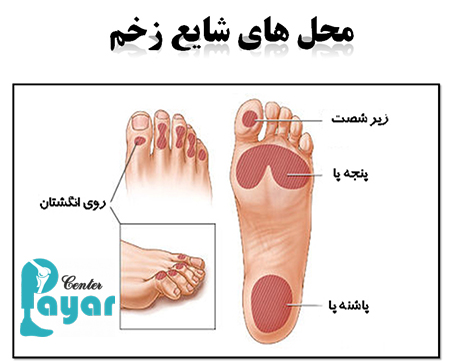در مورد علائم قطع پای دیابتی چه می دانید؟