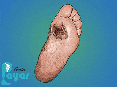 طب سنتی و قطع مراحل اولیه زخم پای دیابتی